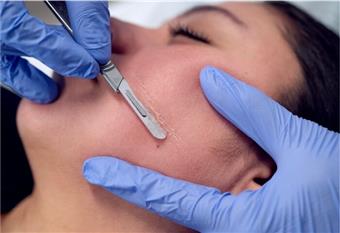 dermaplanning